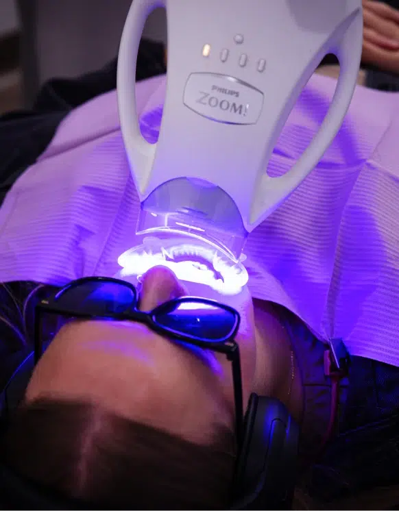 Professional Whitening