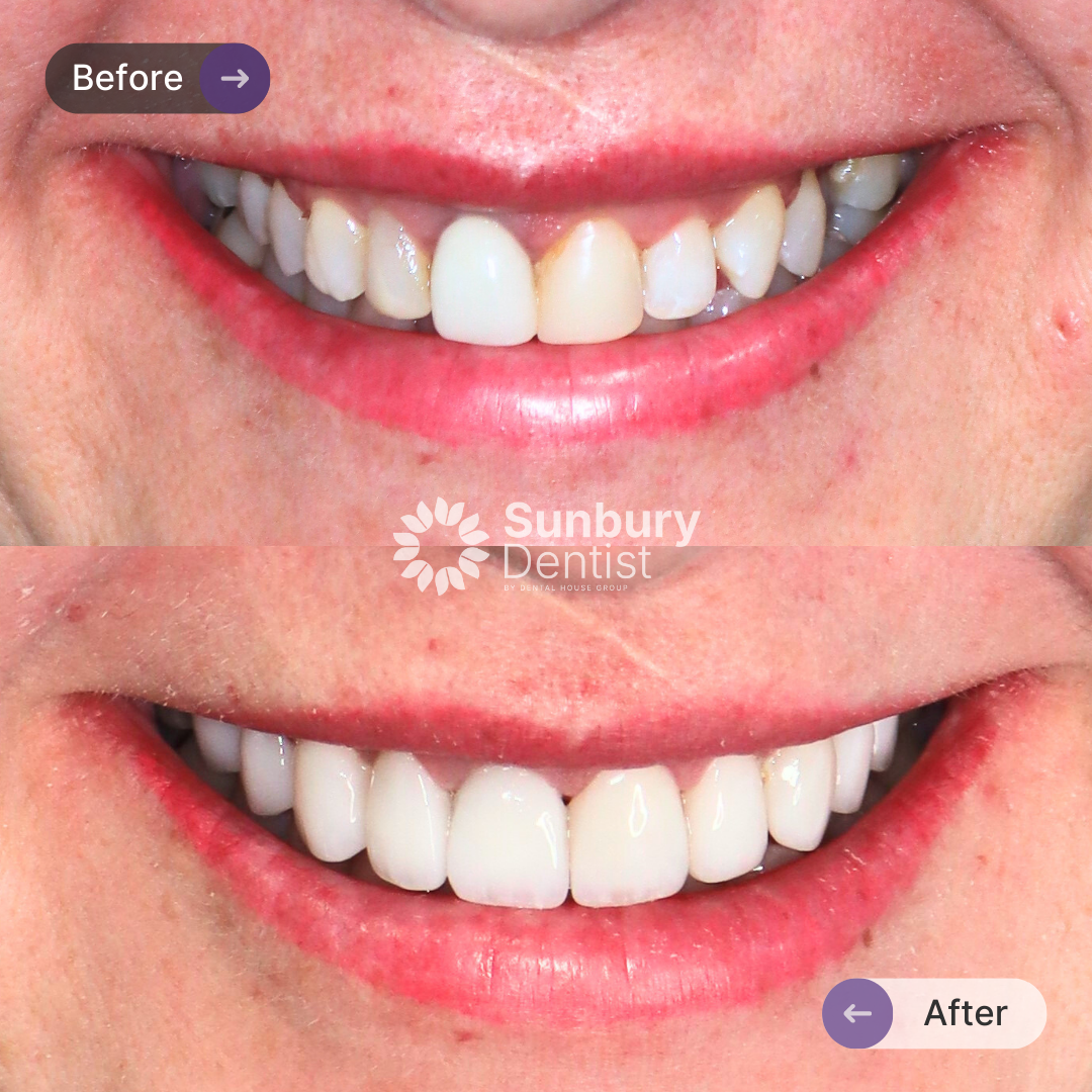 Bett's Crown And Veneers Journey In Sunbury Dentist