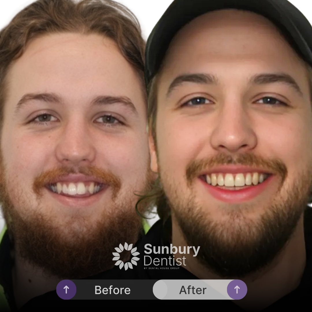 Caleb’s Invisalign Smile Makeover In Sunbury Dentist