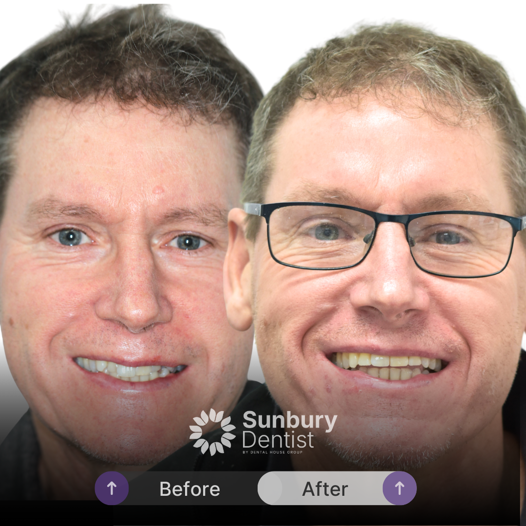 Chris's Invisalign Journey In Sunbury Dentist