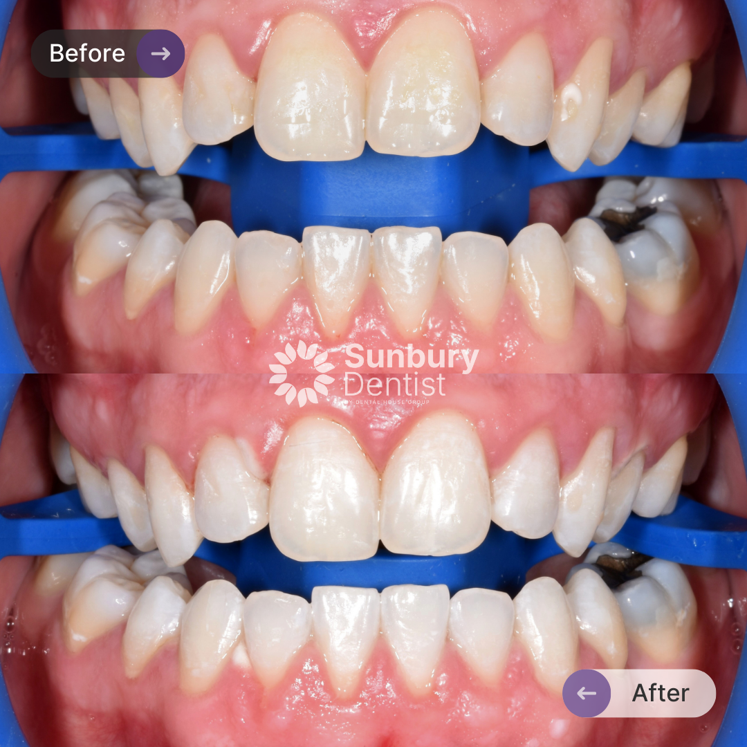 Cory's Teeth Whitening Journey In Sunbury Dentist