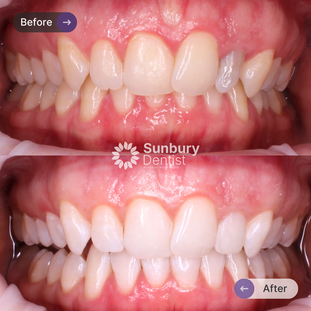Erica's Teeth Whitening Journey In Sunbury Dentist
