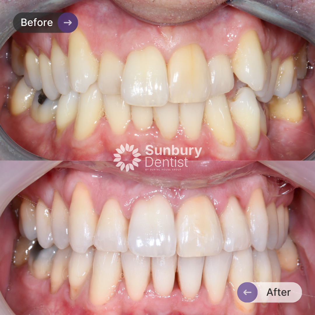 Ian's Invisalign Journey In Sunbury Dentist