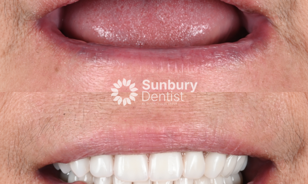 All-on-4 Dental Implants Clinical Case
