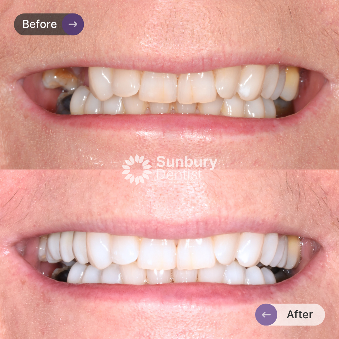 Jo's Teeth Whitening Journey In Sunbury Dentist