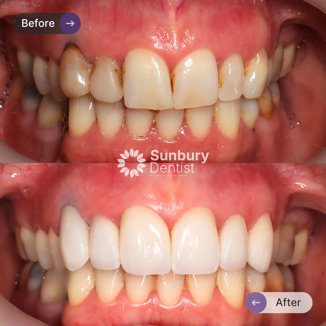 Karyn's Porcelain Crown And Veneers Journey In Sunbury Dentist