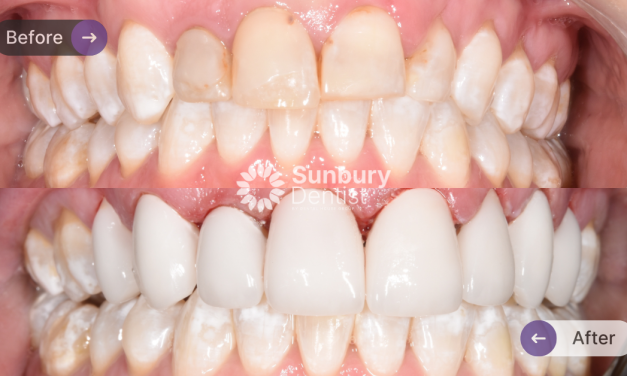 Porcelain Veneers Case Study in Sunbury