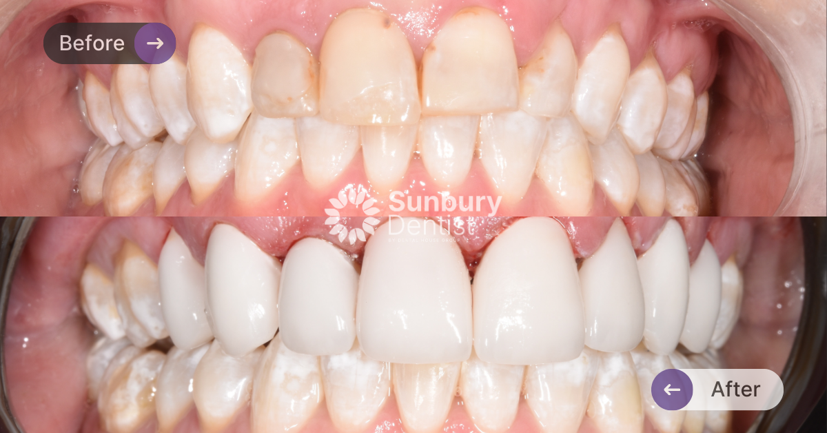 Porcelain Veneers Case Study in Sunbury