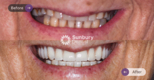 Katies-smile-makeover-in-sunbury-dentist-1