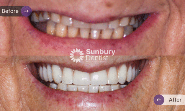 Porcelain Veneers and Crowns Clinical Case
