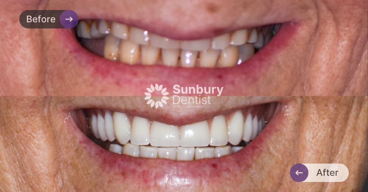 Porcelain Veneers and Crowns Clinical Case