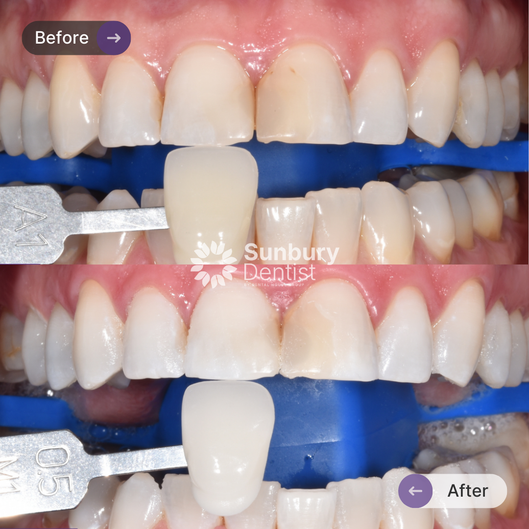 Lily's Smile Makeover In Sunbury Dentist