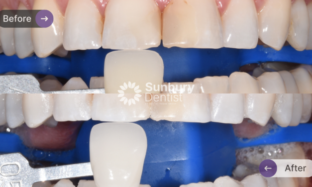 Professional Whitening Case Study in Sunbury