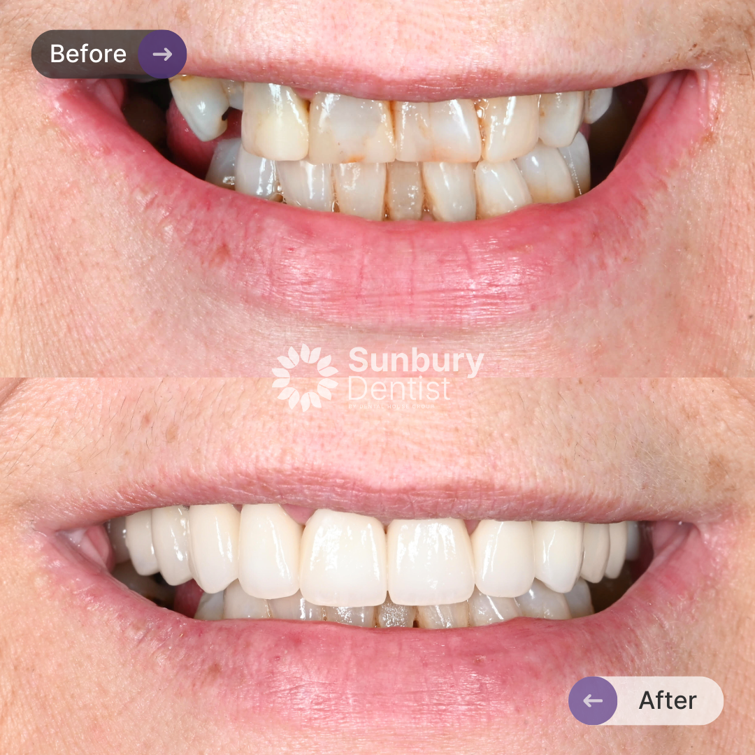Lucia's Porcelain Crown And Bridge Journey In Sunbury Dentist