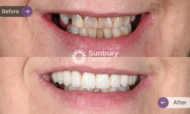 Porcelain Crown & Bridge Replacement Clinical Case in Sunbury
