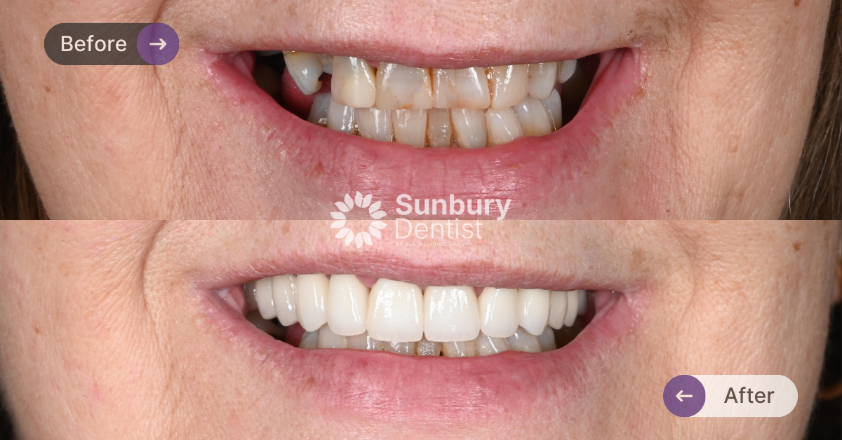 Porcelain Crown & Bridge Replacement Clinical Case in Sunbury