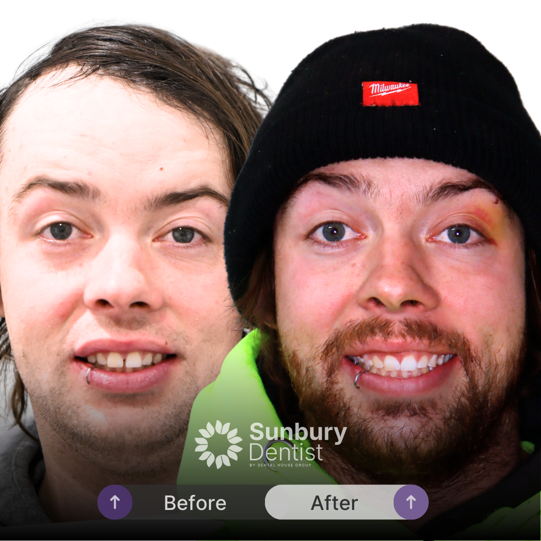 Mitchell's Invisalign Journey In Sunbury Dentist