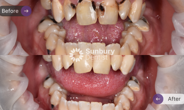 Composite Veneer Clinical Case in Sunbury