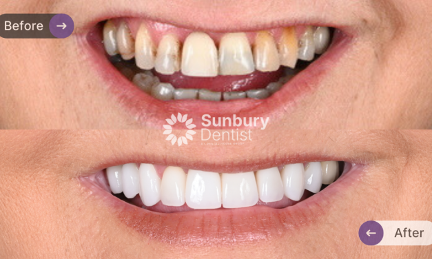 Custom Porcelain Veneers Clinical Case in Sunbury