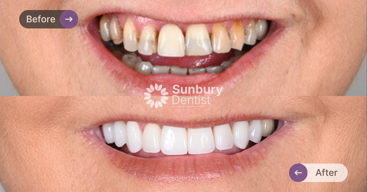 Custom Porcelain Veneers Clinical Case in Sunbury