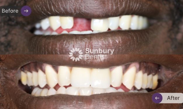 Dental Bridge & Crown Case Study in Sunbury