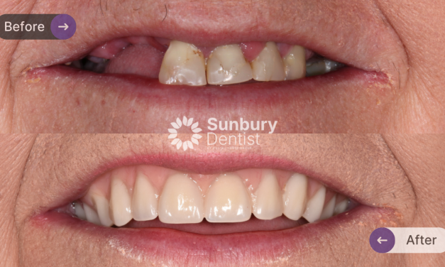 Full Upper Denture Clinical Case in Sunbury