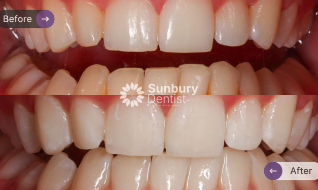 Zoom Teeth Whitening Case Study in Sunbury