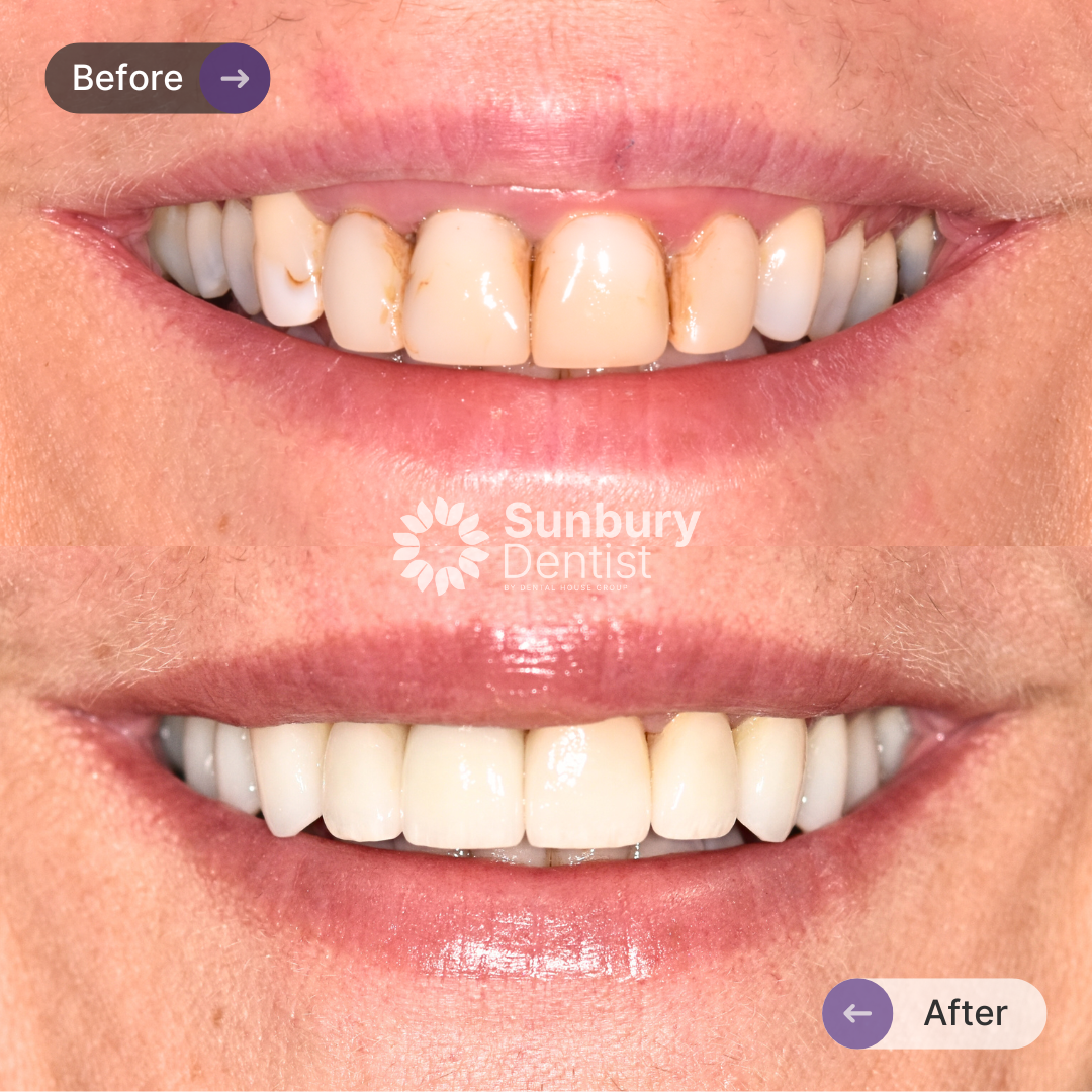 Alisa’s Porcelain Veneers Journey In Sunbury Dentist