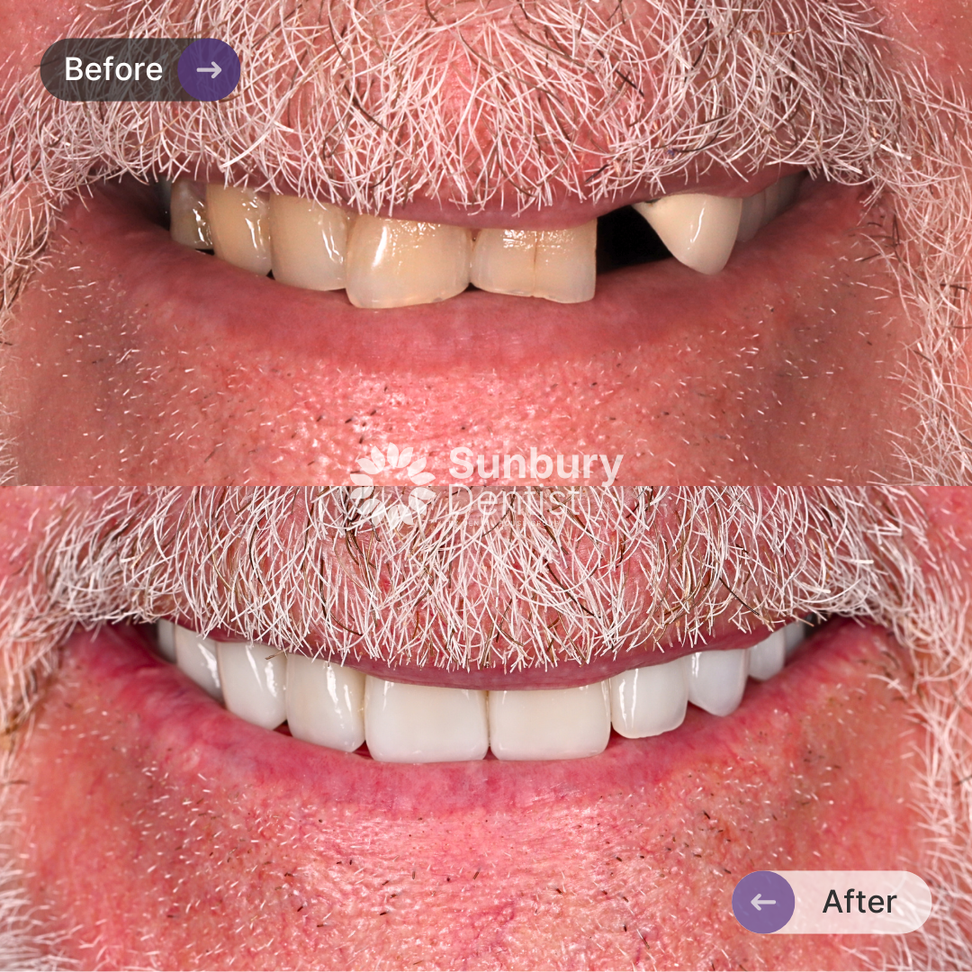 John’s Porcelain Veneers Journey In Melbourne In Sunbury Dentist