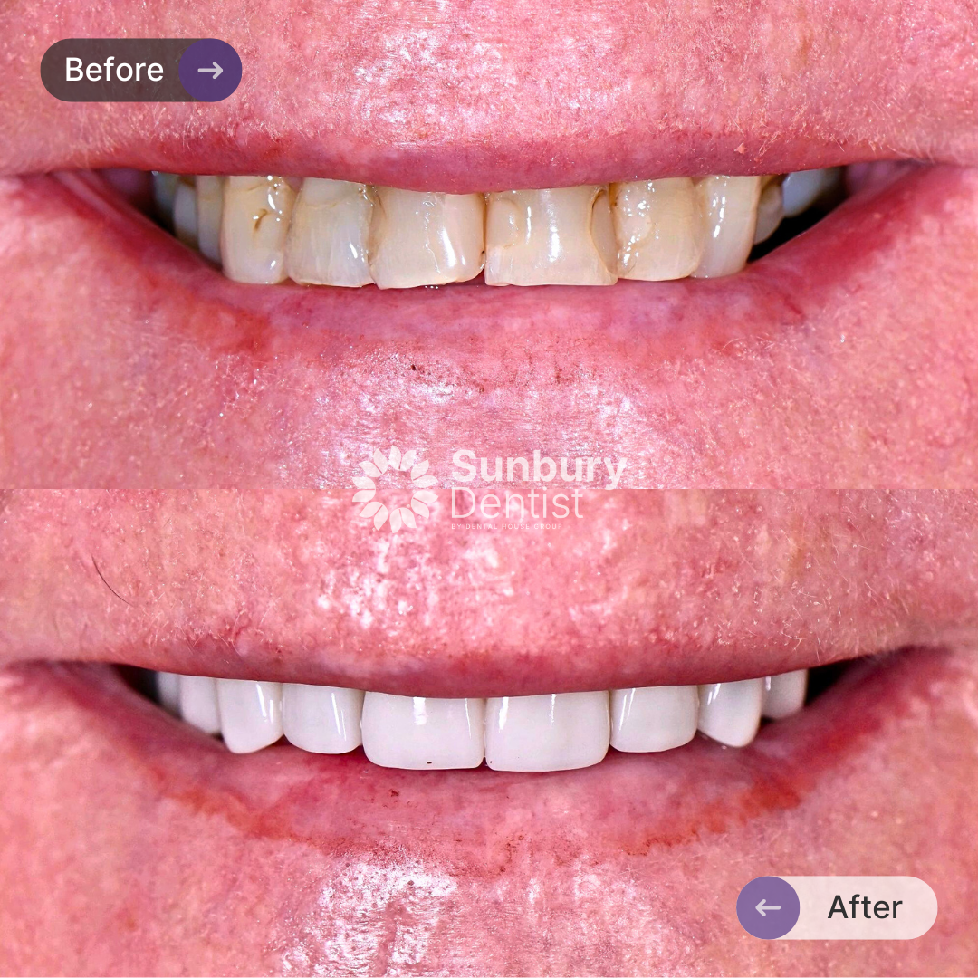 Kathy’s Porcelain Veneers Journey In Melbourne In Sunbury Dentist