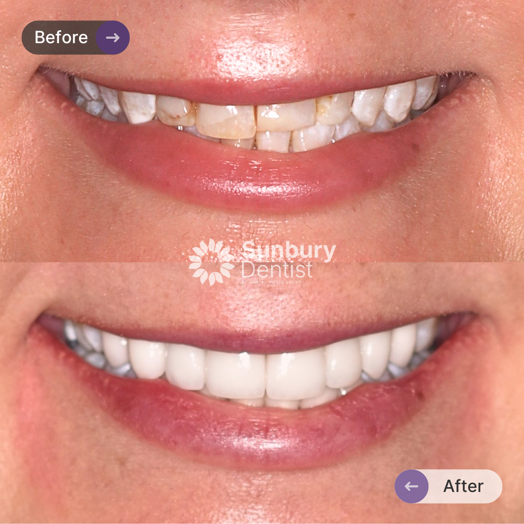Kerry’s Porcelain Veneers Journey In Sunbury Dentist