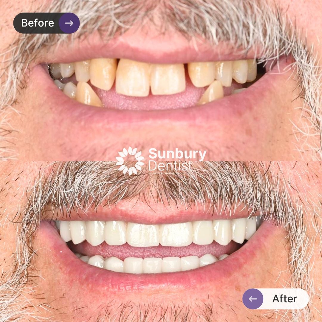 David's All-on-4 Plus® Journey In Sunbury