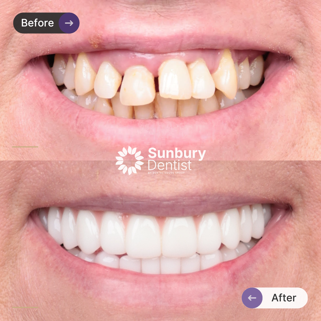 Amber's All-On-4 Plus® Plus® Smile Makeover In Sunbury Dentist