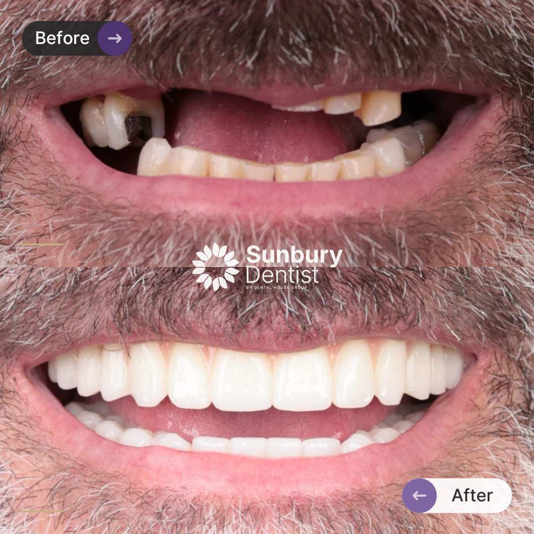 Steve's Upper And Lower All-On-4 Plus® Plus® Smile Makeover In Sunbury Dentist